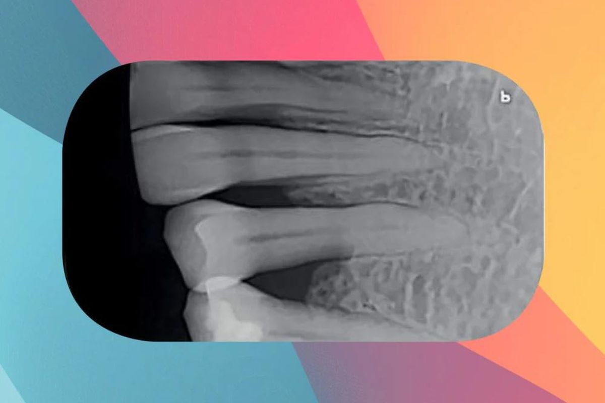 phosphor plate x ray